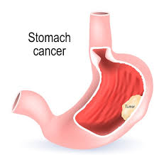 Photo of Stomach cancer